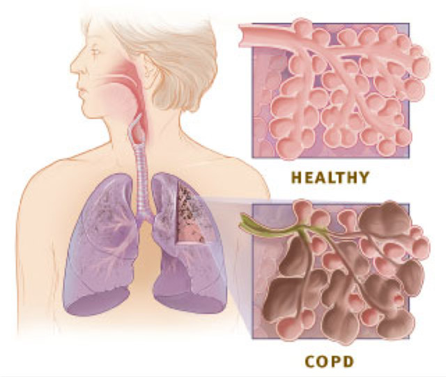 COPD Lung Image